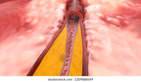 Hypercholesterolemia is a condition characterized by higher-than-average levels of cholesterol in the bloodstream. 3D rendering
