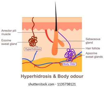 Hyperhidrosis  And  Body Odor