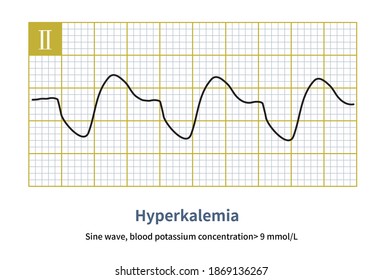 Hyperkalemia Blood Potassium Concentration Increases Certain Stock ...