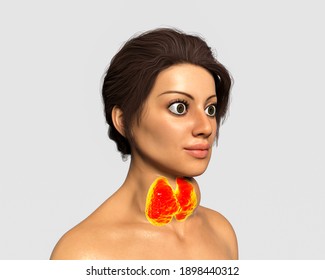 Hyperthyroidism. 3D Illustration Showing Enlarged Thyroid Gland And Exophthalmos (bulging Eyes) In A Female With Graves' Disease, Also Known As Toxic Diffuse Goiter