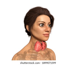 Hyperthyroidism. 3D Illustration Showing Enlarged Thyroid Gland And Exophthalmos (bulging Eyes) In A Female With Graves' Disease, Also Known As Toxic Diffuse Goiter