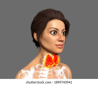 Hyperthyroidism. 3D Illustration Showing Enlarged Thyroid Gland And Exophthalmos (bulging Eyes) In A Female With Graves' Disease, Also Known As Toxic Diffuse Goiter