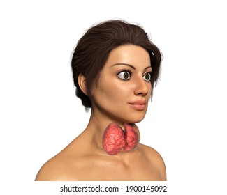 Hyperthyroidism. 3D Illustration Showing Enlarged Thyroid Gland And Exophthalmos (bulging Eyes) In A Female With Graves' Disease, Also Known As Toxic Diffuse Goiter