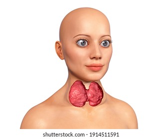 Hyperthyroidism. 3D Illustration Showing Enlarged Thyroid Gland And Exophthalmos (bulging Eyes) In A Female With Graves' Disease, Also Known As Toxic Diffuse Goiter