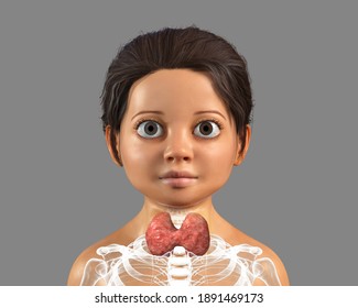 Hyperthyroidism In Children, Pediatric Thyrotoxicosis. 3D Illustration Showing Enlarged Thyroid Gland And Exophthalmos (bulging Eyes) In A Girl With Graves' Disease, Also Known As Toxic Diffuse Goiter