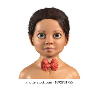 Hyperthyroidism In Children, Pediatric Thyrotoxicosis. 3D Illustration Showing Enlarged Thyroid Gland And Exophthalmos (bulging Eyes) In A Girl With Graves' Disease, Also Known As Toxic Diffuse Goiter