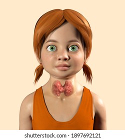 Hyperthyroidism In Children, Pediatric Thyrotoxicosis. 3D Illustration Showing Enlarged Thyroid Gland And Exophthalmos (bulging Eyes) In A Girl With Graves' Disease, Also Known As Toxic Diffuse Goiter