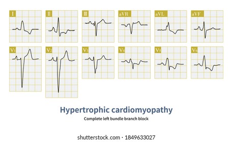 Hypertrophic Cardiomyopathy Can Also Present Complete Left Bundle Branch Block.