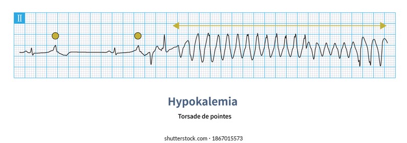 Hypokalemia Leads To Prolonged QT Interval Of Electrocardiogram, Prone To R-on-T Ventricular Premature Beats, And Induce Malignant Ventricular Arrhythmia.