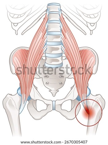 Iliopsoas tendonitis is inflammation of the iliopsoas tendon, causing hip pain, stiffness, and discomfort during movement. Common in athletes, it results from overuse, strain, or repetitive stress.
