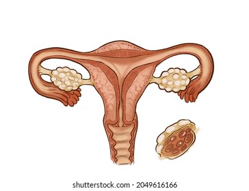 Illustrated Health Diagram Of Woman’s Uterus With Polycystic Ovarian Syndrome (PCOS)