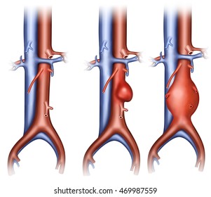 Illustration abdominal arteries with two different types of aneurysm.