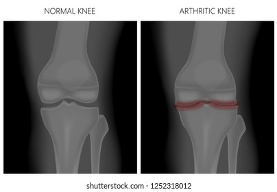 Illustration. Anatomy, Front X-ray Of A Healthy Knee Joint And An Arthritic Knee. For Advertising And Medical Publications. 