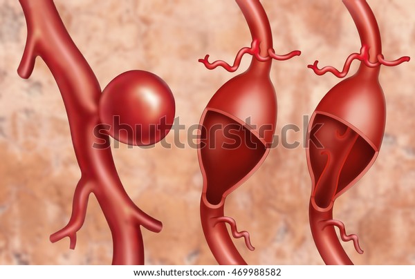 Illustration Arteries Different Types Aneurysm Fusiform Stock ...