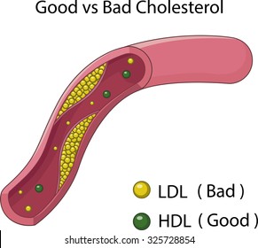 Illustration of an Artery blocked with bad cholesterol