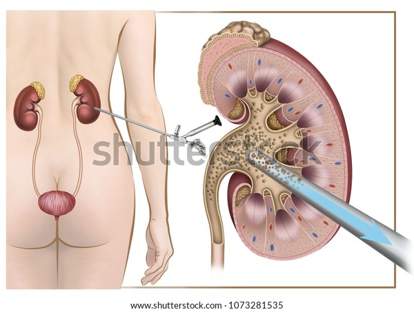 膀胱と尿道の図で 尿管鏡を使って結石や腎臓結石を取り除く様子を見ることができます のイラスト素材