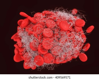 Illustration Of A Blood Clot Showing A Clump Of Red Blood Cells Intertwined In A Fibrin Mesh