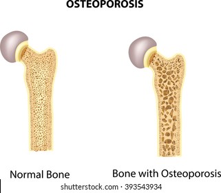 1,438 Osteoporosis cartoon Images, Stock Photos & Vectors | Shutterstock