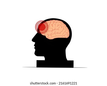 Illustration Of Brain Trauma And Headache