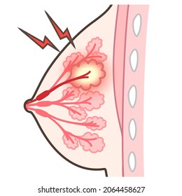 A Illustration Of Breast  Which Has  Mastitis.