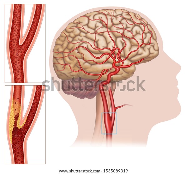 Illustration carotid artery\
disease, this affects the blood vessels that lead to the head and\
brain, the carotid becomes clogged and the brain does not receive\
enough\
oxygen.