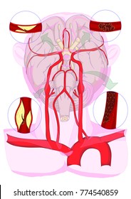 Illustration of circulation of brain. Including demonstration of causes of ischemic stroke such as carotid stenosis, carotid dissection, cerebral embolization, and large vessel thrombosis. 