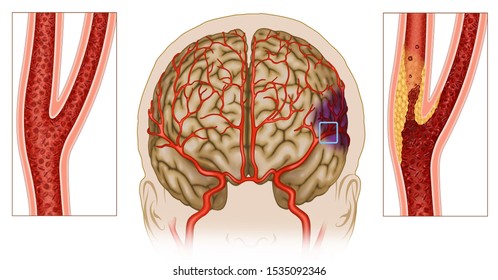 Illustration clogged cerebral arteries, carotid artery disease, the carotid is clogged with accumulation of cholesterol, plaques and the brain does not receive enough oxygen.
