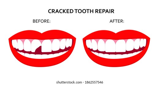 Illustration Of Cracked Tooth Repair. Smile Mouth With Cracked Tooth Before And After Repair. Isolated On White Background. Good For Posters, Banners. Infographic.