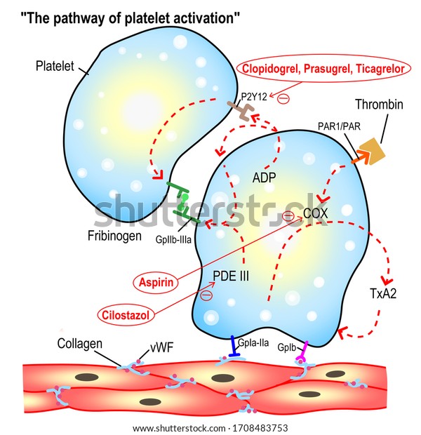 The illustration demonstrates the pathway of\
platelet activation and the mechanisms of antiplatelet agents\
preventing local thrombosis. it is the common cause of ischemic\
stroke and heart\
attack.