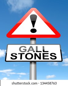 Illustration Depicting A Sign With A Gall Stones Concept.