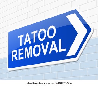 Illustration Depicting A Sign With A Tatoo Removal Concept.