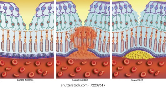 Illustration Of Dry And Wet AMD