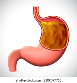 An Illustration Of A Gastric Reflux, Dissected To Show The Inside, For Medical And Educational Use.