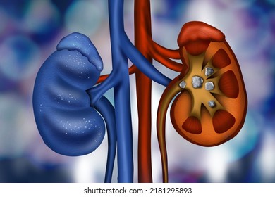 Illustration Healthy Diseased Kidneys On Blue Stock Illustration ...