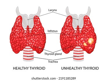 Illustration Healthy Diseased Thyroid On White Stock Illustration ...