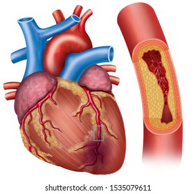 Illustration of the heart with coronary artery disease, the main blood vessel that supplies blood, oxygen and nutrients, has accumulation of cholesterol (plaque) and narrows the artery, which decrease