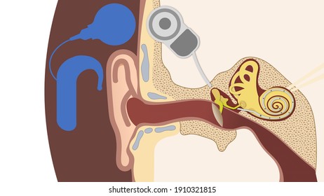 Illustration of how the cochlear implantation system works in ear anatomy
