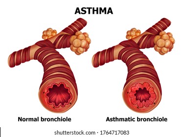 Illustration Human Asthma Anatomy Stock Illustration 1764717083 ...