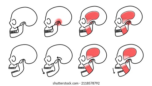 Illustration Of Lateral View Of Human Skull, Normal Skull, Mouth Opening, Red Highlight On TMJ, Muscle Of Mastication, Dental Icon For Occlusion.