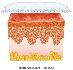 Illustration On Diaper Rash 