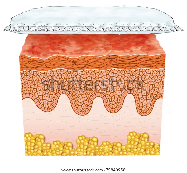 Illustration On Diaper Rash Stock Illustration 75840958