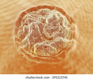 An illustration of a Plantar Wart, or Verruca Plantaris up-close on the skin. Verruca Plantaris is a wart caused by the human papillomavirus (HPV) occurring on the sole or toes of the foot.