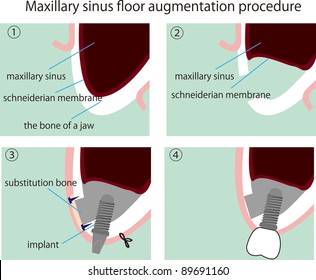 Illustration Of The Process Of Maxillary Sinus Floor Augmentation Procedure