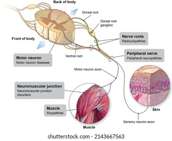 An Illustration Showing A Cross-section Of The Human Spinal Cord And Selected Pathologies Involving Motor And Sensory Neurons.