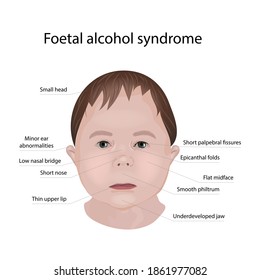 17 Foetal alcohol syndrome Images, Stock Photos & Vectors | Shutterstock