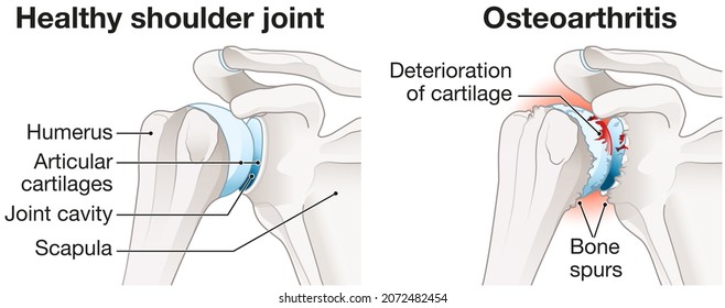 Illustration Showing Healthy Shoulder Joint And Osteoarthritis