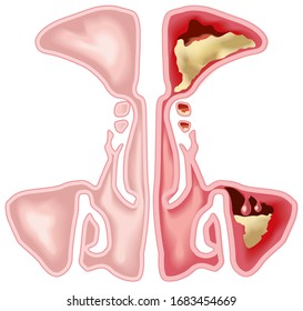 Illustration showing healthy sinus and sinusitis with inflamed lining, obstructed sinus opening, adenoid and excess mucus