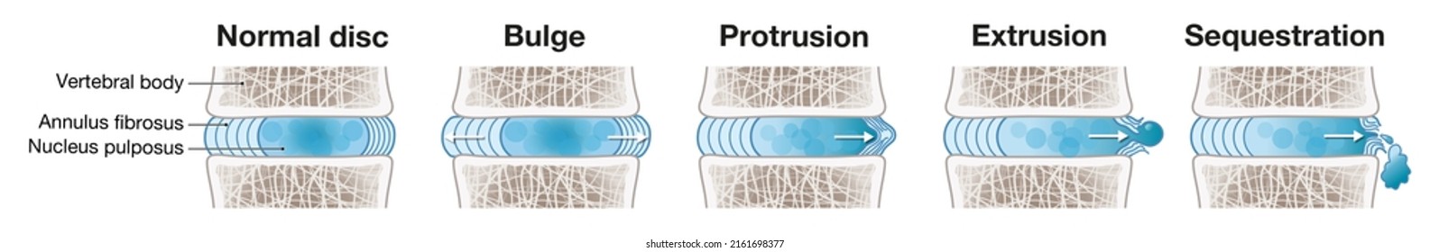 Illustration Showing Herniated Disc Schema. Normal Disc. Bulge. Protrusion. Extrusion. Sequestration. Labeled Illustration