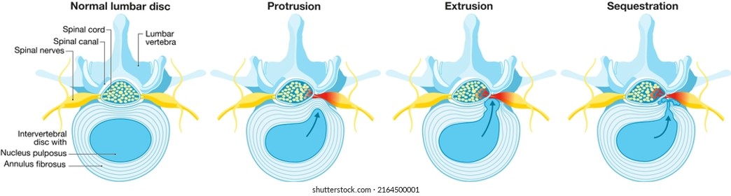 Illustration showing herniated disc schema. Normal disc. Bulge. Protrusion. Extrusion. Sequestration. Labeled illustration