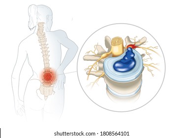 illustration showing lumbal vertebra with intervertebral disc and herniated nucleus pulposus